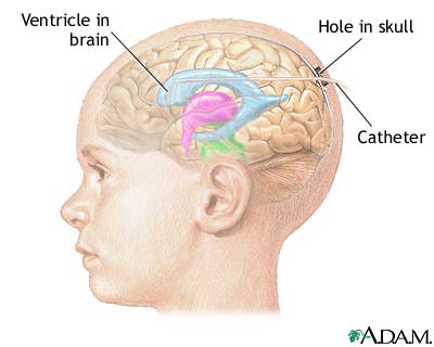 Intracranial pressure monitoring