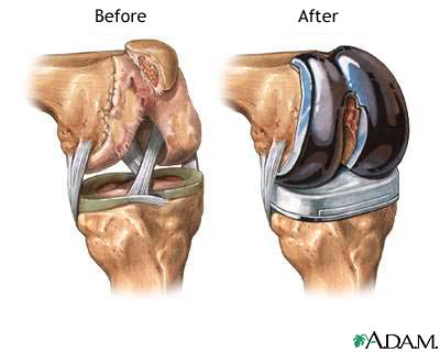 Knee joint replacement prosthesis