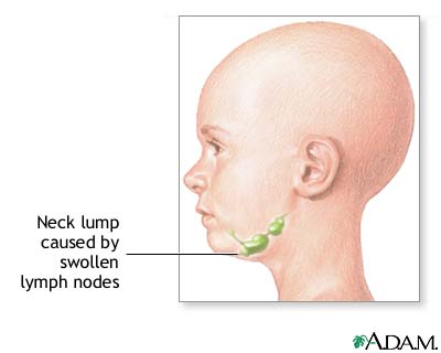 Neck lump