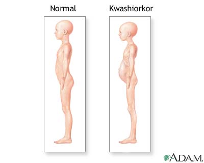 Kwashiorkor symptoms