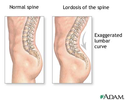 Lordosis