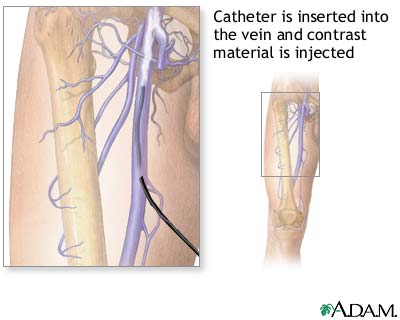 Leg venography