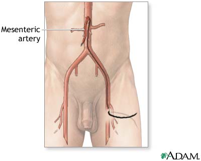 Mesenteric arteriography