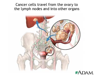 Ovarian cancer metastasis