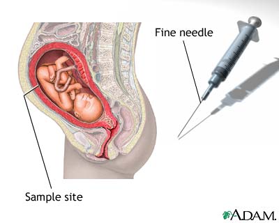 Amniocentesis