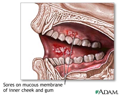 Mouth sores