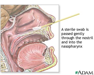 Nasopharyngeal culture