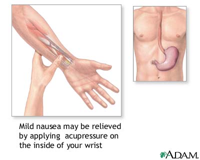 Nausea acupressure