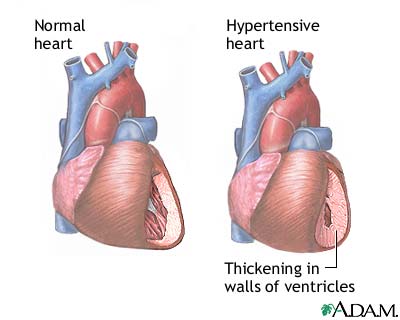 Hypertension