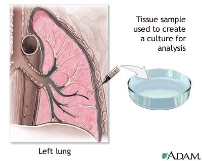 Pleural culture