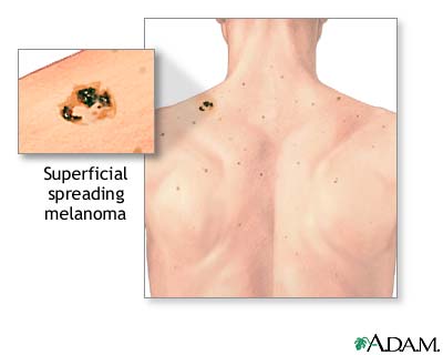 Melanoma