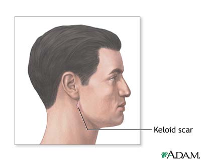 Keloid scar