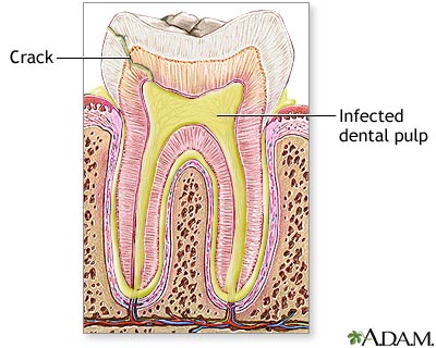 Tooth abscess