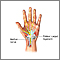 Carpal tunnel repair - series