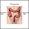 Large bowel resection - series