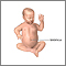 Umbilical hernia repair  - series