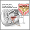 Bladder catheterization, female