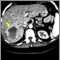 Hemangioma - CT scan