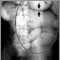 Ileus - X-ray of bowel distension