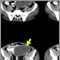 Intra-abdominal abscess, CT scan