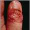 Herpetic whitlow on the thumb