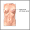 Breast reconstruction - series