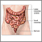 Colon cancer - series