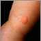 Ringworm, tinea corporis on an infant's leg