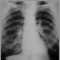 Coal worker's lungs - chest X-ray