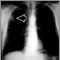 Lung mass, right upper lung - chest X-ray