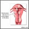 Fibroid tumors