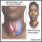 Hyperthyroidism