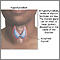 Hypothyroidism