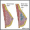 Fibrocystic breast disease