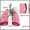 Adenocarcinoma