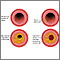 Developmental process of atherosclerosis