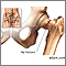 Hip fracture