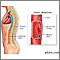 Aortic dissection