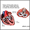 Aortic insufficiency