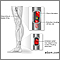 Arterial embolism