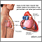 Post-MI pericarditis