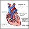 Tetralogy of Fallot