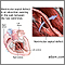 Ventricular septal defect