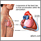 Cardiac tamponade