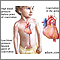 Coarctation of the aorta