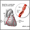 Coronary artery spasm