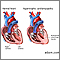 Hypertrophic cardiomyopathy