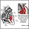 Mitral valve prolapse