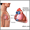 Pericarditis