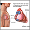 Bacterial pericarditis